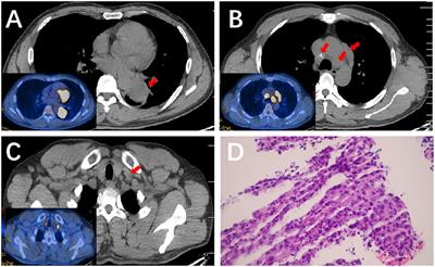 Conversion therapy with immunotherapy plus chemotherapy achieves a pathological complete response in stage IIIC NSCLC